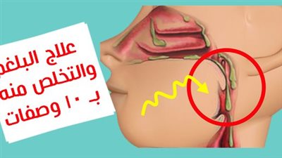 بدون أدوية ١٠ وصفات عالج بها نفسك من البلغم