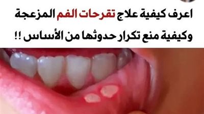 هذه هي أعراض تقرحات الفم وكيفية علاجها ومنع حدوثها من الأساس – دليل شامل