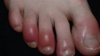 علامات تحذيرية في قدميك تخبرك أن كبدك في ورطة