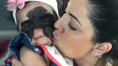 لقبت بالۏحش.. لن تصدق كيف أصبح شكل الطفلة ذات الوحمة الكبيرة بعد عملېة التجميل